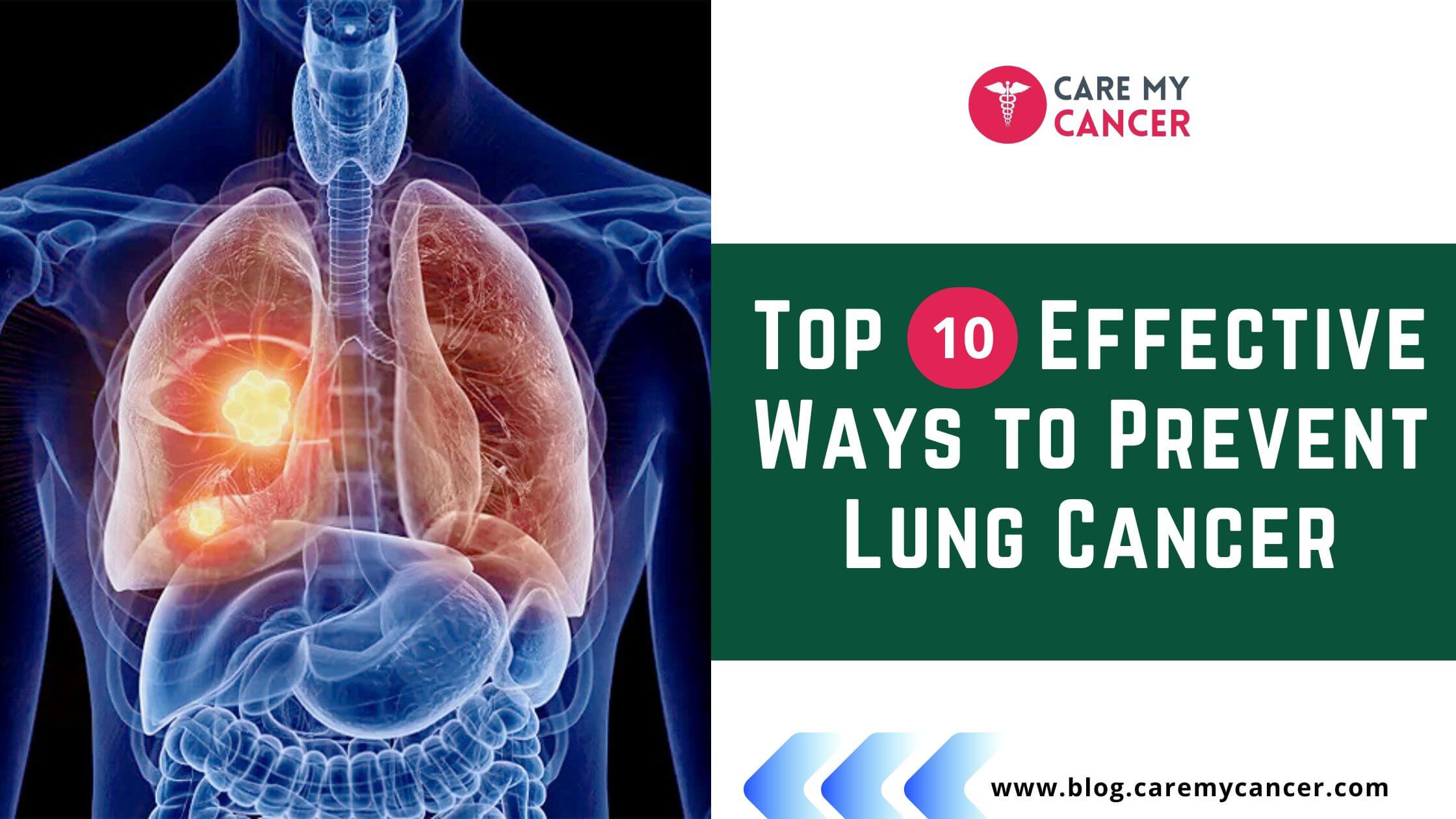 lung cancer