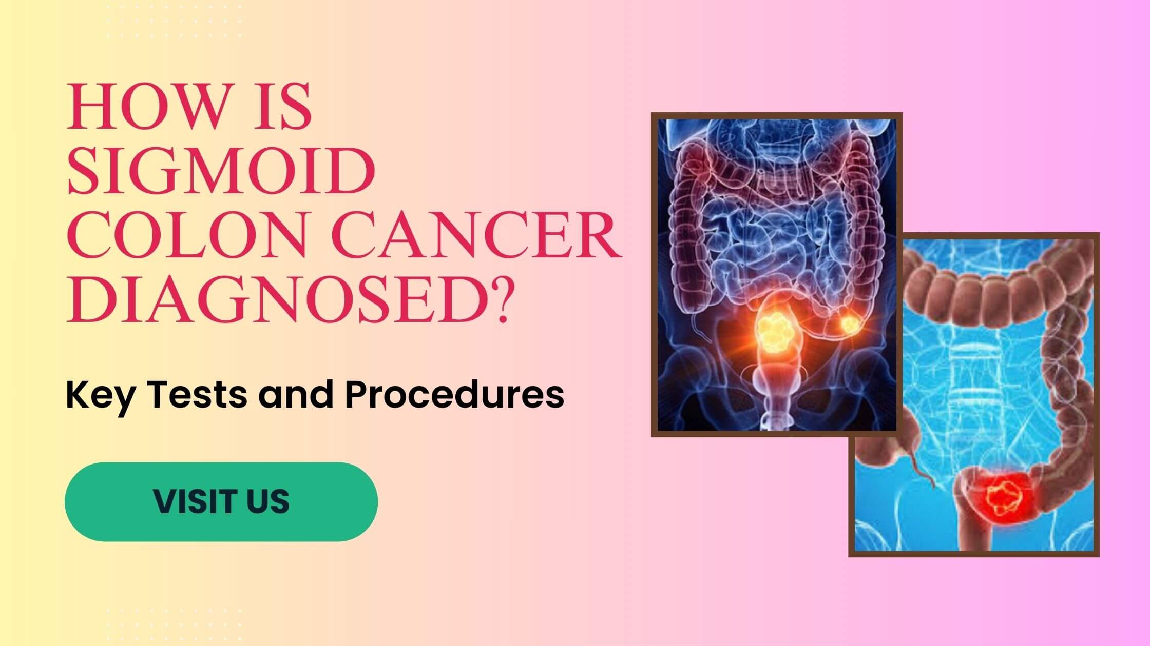 Sigmoid Colon Cancer Diagnosed