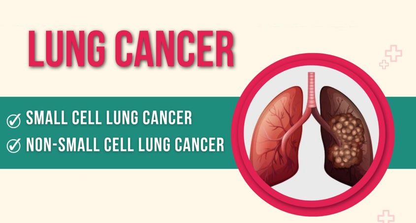 Types of Lung Cancer