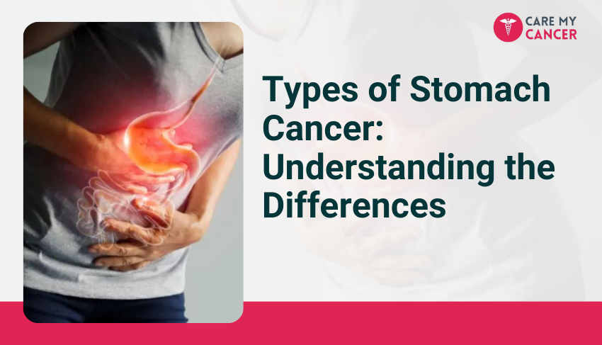 various types of stomach cancer