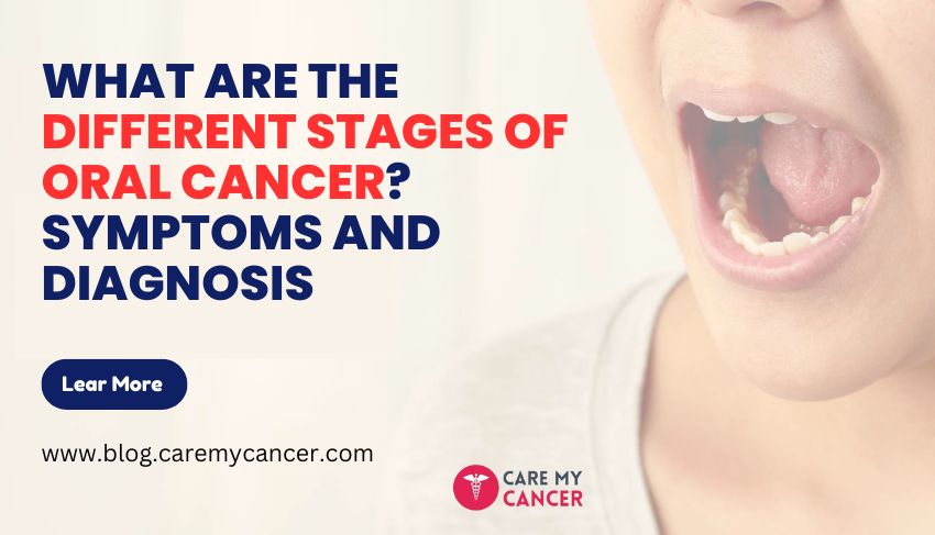 Different Stages of Oral Cancer