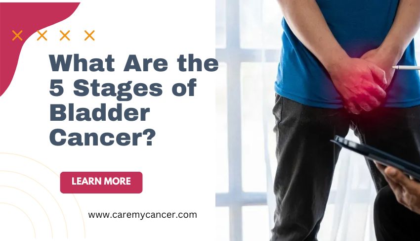 What Are the 5 Stages of Bladder Cancer