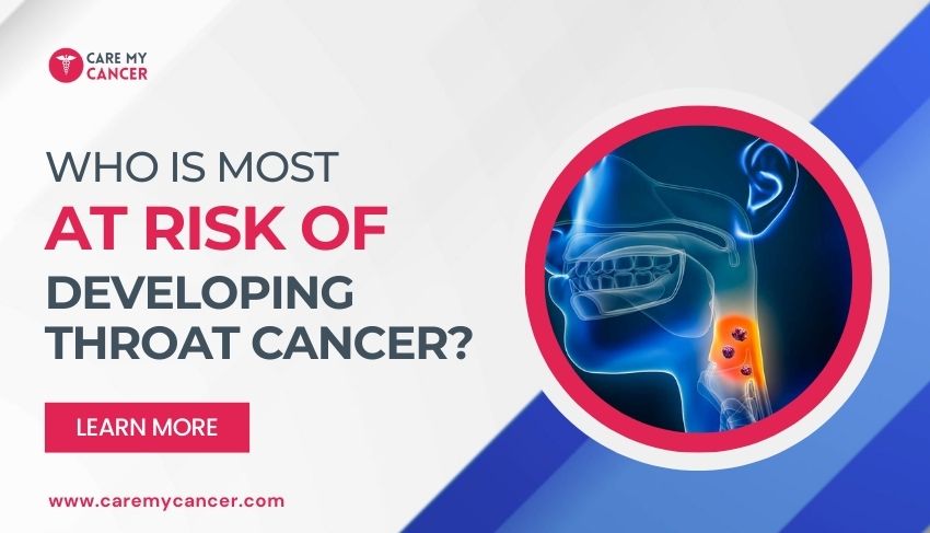 Developing Throat Cancer
