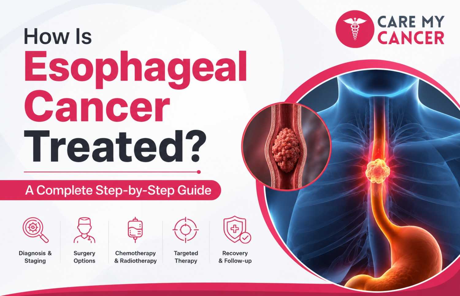How Is Esophageal Cancer Treated