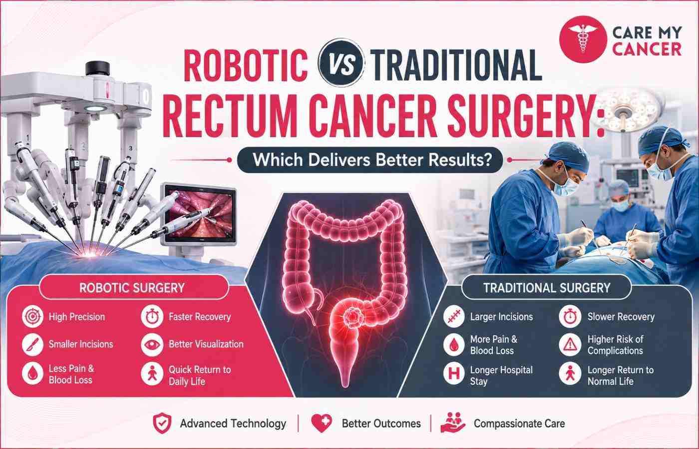 Robotic vs Traditional Rectum Cancer Surgery